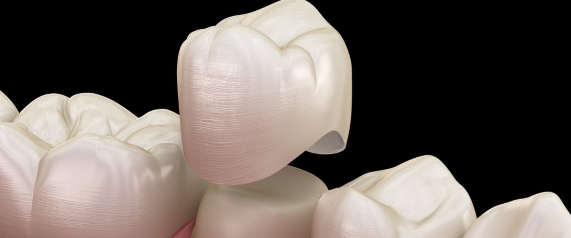 What Materials Can NHS Dentists Use for Fillings and Crowns in the UK?