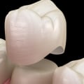 What Materials Can NHS Dentists Use for Fillings and Crowns in the UK?