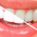 What is the Difference Between NHS and Private Dentistry in the UK?
