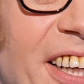 Are British Teeth Really Better than American Teeth?