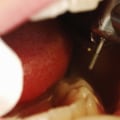 Can a Dentist Refuse Treatment in the UK?