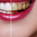How Much Does it Cost to Get Veneers Fitted at a UK Dentist?