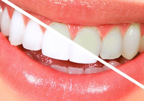 What is the Difference Between NHS and Private Dentistry in the UK?