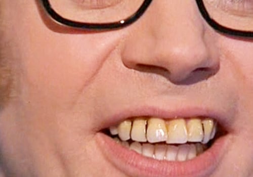 Are British Teeth Really Better than American Teeth?