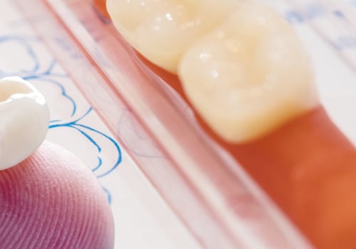 How Much Does it Cost to Get a Crown Fitted at a UK Dentist?