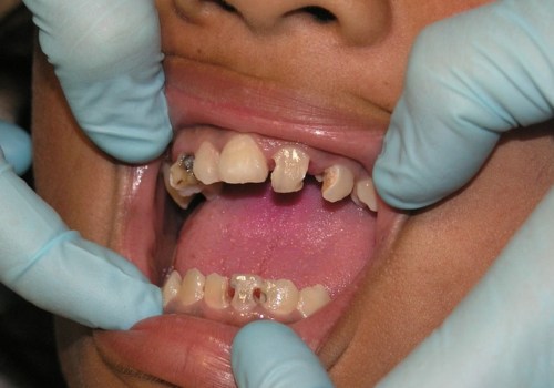 Which Country Has the Best Dental Care?